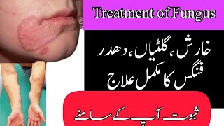 Fungal Skin Infection Treatment By Hakeem Sarfraz Multani 03036491983 [upl. by Fagan]