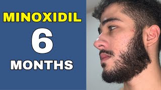 Minoxidil Beard Journey 6 MONTHS TRANSFORMATION [upl. by Skelly864]