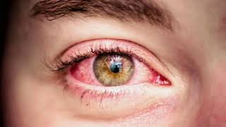 What is Eye Strain and How to prevent Eye Strain [upl. by Eednyl852]