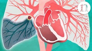 Pulmonary embolism The route to recovery [upl. by Eifos]