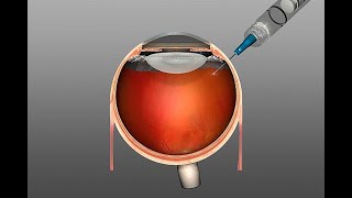 Spritze ins Auge  bei AMD diabetischem Makulaödem retinalen Gefäßverschlüssen [upl. by Ursula]