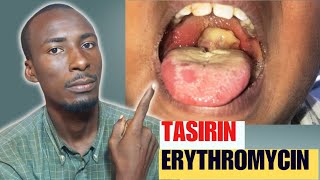 YADDA AKE SHAN ERYTHROMYCIN  HOW TO USE ERYTHROMYCIN [upl. by Inanaup]