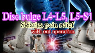 Disc bulge L4L5 L5S1 Sciatica pain relief backpainrelief backpain [upl. by Normi]