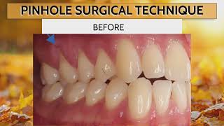 Dr Nemeths Success in Reversing Gum Recession 🦷 🔄 [upl. by Eiramyelhsa]