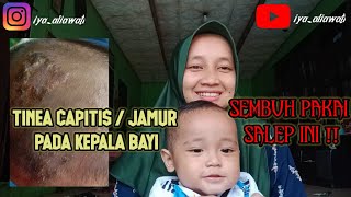 Cara Mengobati Tinea Capitis  Jamur Pada Kepala Bayi [upl. by Ohcirej317]