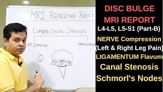 Herniated disc MRI How to read MRI lumbar spine Nerve compression L4L5 L5S1 Canal Stenosis [upl. by Soni130]