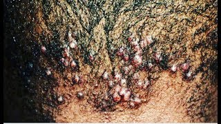 A Closer Look at Folliculitis And How To Treat ItThe Organic Way [upl. by Docilla402]