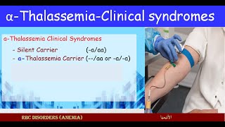 Lecture 251 Carriers alfa Thalassemia  Clinical Syndromes [upl. by Savdeep]