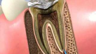 Traitement canal dentaire et pose dun inlaycore [upl. by Slack]