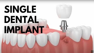 Single Dental Implant Procedure Animated [upl. by Benedikta]