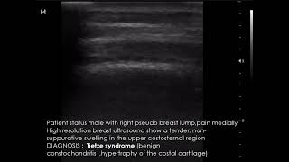 CASE 956 Tietze syndrome [upl. by Gardia639]