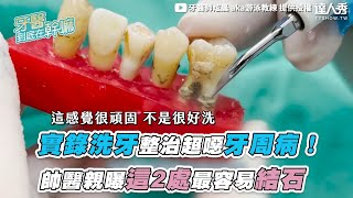 【實錄洗牙整治超噁牙周病！ 帥醫親曝這2處最容易結石】｜dentistxuan [upl. by Icyaj]