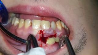 PUS ABSCESS INCISION DRAINAGE Endodontic Root Canal Treatment [upl. by Lucky]