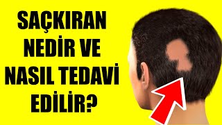 SAÇKIRAN NEDİR VE NASIL TEDAVİ EDİLİR [upl. by Cohdwell]