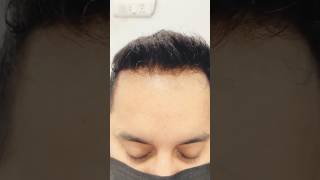 frontline hair patch in delhi  natural hairline  skin base reels ytshorts tutorial patch best [upl. by Kreda]