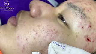 Loan Nguyen Acne Treatment 73b [upl. by Goetz]