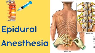 Epidural Anesthesia [upl. by Weylin]