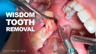 Wisdom tooth removal in 5 MIN or less Surgical Guide Online Course  Free eBook [upl. by Krisha298]