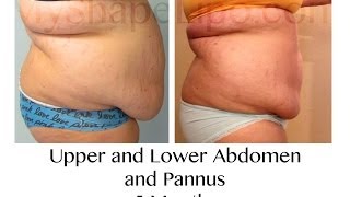 MyShape Lipo  Large Volume Liposuction to Abdomen [upl. by Dnomde]