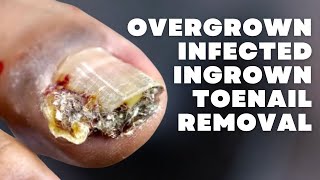 OVERGROWN INFECTED INGROWN TOENAIL REMOVAL WITH A SUPER SURPRISE [upl. by Pulcheria]