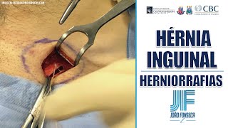 HÉRNIAS ABDOMINAIS Parte 8 INGUINAL E FEMORAL HERNIORRAFIAS 👨🏽‍⚕️🚑 Joao Fonseca Cir Geral [upl. by Nicholas238]