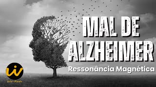 MAL DE ALZHEIMER  Aspecto na Ressonância Magnética de Crânio da Atrofia [upl. by Simona699]