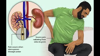 What is uremia Causes of Uremia sign and symptoms of uremia Treatment of Uremia  in HindiUrdu [upl. by Gonsalve269]