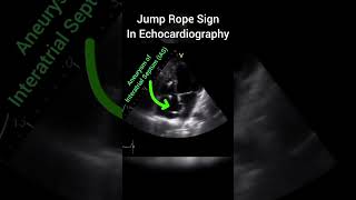 Aneurysm of InterAtrial Septum  Jump Rope sign in Echocardiography [upl. by Zapot]