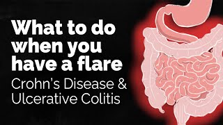 Crohns Disease vs Ulcerative Colitis  Quick Bites Internal Medicine Gastroenterology [upl. by Urias431]