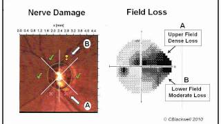 Glaucoma 1 Diagnosis [upl. by Ayanat868]