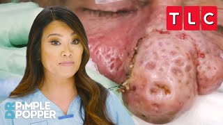 Bumpiest Nose Growths  Dr Pimple Popper  TLC [upl. by Amimej]