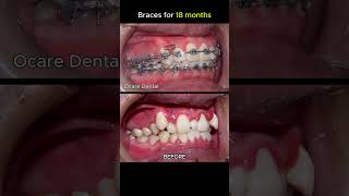 18 months braces process [upl. by Carley]