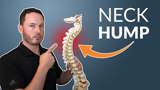 How To Correct Your NECK HUMP  Simple Stretch amp Exercise [upl. by Sotsirhc]