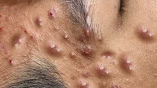 Big Cystic Acne Blackheads Extraction Blackheads amp Milia Whiteheads Removal Pimple Popping [upl. by Clava]