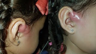 Life Update My 2 yr old has Preauricular Sinus Infections [upl. by Rockafellow]