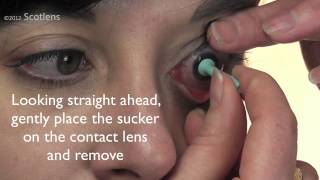 GP contact lens removal with sucker [upl. by Odnama608]