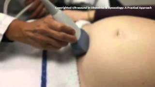 Ultrasound in Obstetrics amp Gynecology A Practical Approach  Clip 101 [upl. by Jacinto]