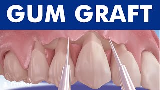 Gum graft  Coronally advanced flap  Receding gums treatment © [upl. by Heeley346]