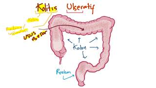 Patofisiologi  Kolitis Ulseratif Penyakit Radang Usus Besar [upl. by Silrak]