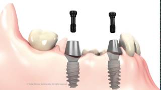 3 unit Bridge on implant abutments [upl. by Noxas456]