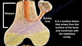 Osteochondroma  solitary and multiple  Everything You Need To Know  Dr Nabil Ebraheim [upl. by Odlavso]