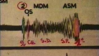 Bases de la Auscultacion Cardiaca II [upl. by Dey468]