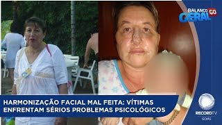 HARMONIZAÇÃO FACIAL MAL FEITA VÍTIMAS ENFRENTAM SÉRIOS PROBLEMAS PSICOLÓGICOS [upl. by Hasty]