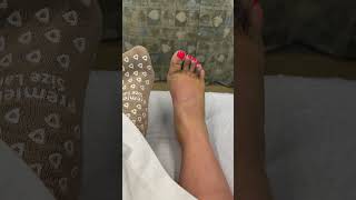 6 weeks of Lisfranc injury ORIF surgery and healing in 24 seconds [upl. by Bebe]