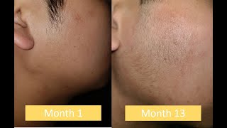 Minoxidil Beard Asian  13 Month Progress [upl. by Sellers]