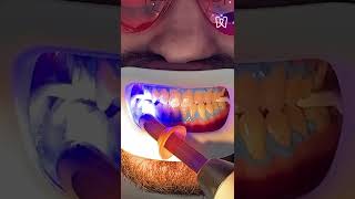 Teeth whitening process [upl. by Anilet]