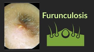 Furunculosis  Ear Nose Throat [upl. by Richy542]