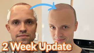 Hair Transplant 2 Week Update Timelapse [upl. by Slaohcin63]