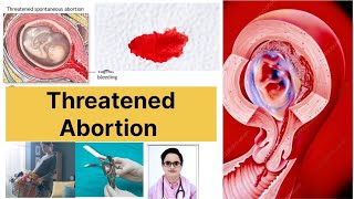 Threatened AbortionSecond Trimester Abortionsymptoms of AbortionDr Naima Bano Shifa Clinic [upl. by Sarid]