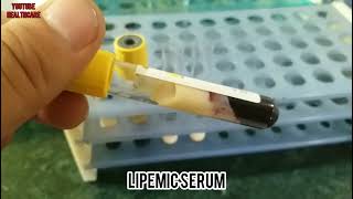 What Cause Blood to Appear Milky and White What is Lipemic Serum [upl. by Egiaf]